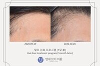 탈모 치료 전후 사진 (전: 2020.09.19, 후: 2020.10.28)