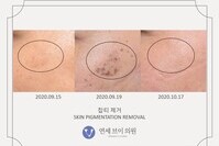 피부 잡티 제거 전후 사진