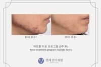 여드름 치료 전후 사진 (전:  2020.10.17, 후: 2020.11.23)