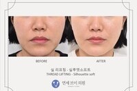실리프팅 전후 사진 (전:  2020.10.12, 후: 2020.11.03)