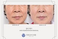 피부 잡티 제거 전후 사진