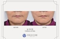 실리프팅 전후 사진 (전: 2020.10.15, 후: 2020.10.15) 