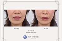 실리프팅 전후 사진 (전:  2020.10.18, 후: 2020.10.18)