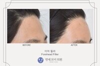 이마 필러 (전:2021.03.30, 후:2021.03.30_