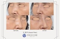 코 필러 (전:2021.04.30, 후:2021.04.30)