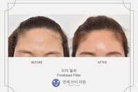 이마 필러 (전:2021.07.01, 후:2021.07.12)