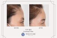 이마 필러 (전:2021.07.01, 후:2021.07.12)