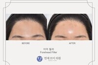 이마 필러 (전:2021.03.30, 후:2021.03.30)