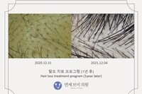 탈모 치료 전후 사진 (전: 2020.12.31, 후: 2021.12.04)