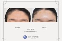 이마 필러 전후 사진 (전:2022.02.03, 후:2022.02.03)