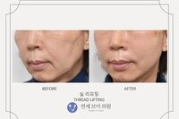 실리프팅 전후 사진 (전:2021.12.07, 후:2021.12.07)