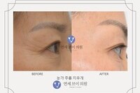 눈가주름지우개 전후사진 (전: 2020.09.03, 후: 2020.09.24)