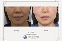 실리프팅 전후사진 (전:  2020.09.12, 후: 2020.09.15)