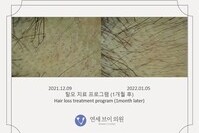 탈모 치료 전후 사진 (전: 2021.12.09, 후: 2022.01.05)