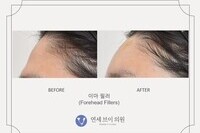 이마 필러 전후 사진 (전:2022.02.03, 후:2022.02.03)